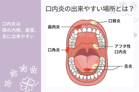 口穴|口内炎で穴が空く？悪化する口内炎の原因 